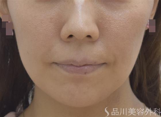 症例NO.45066のBEFORE写真