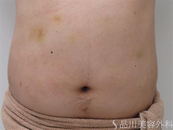 症例NO.26106のBEFORE写真