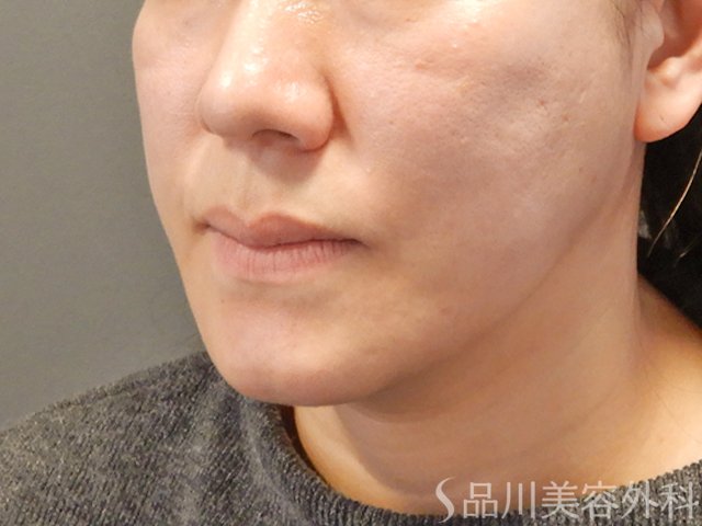 症例NO.75065のAFTER写真