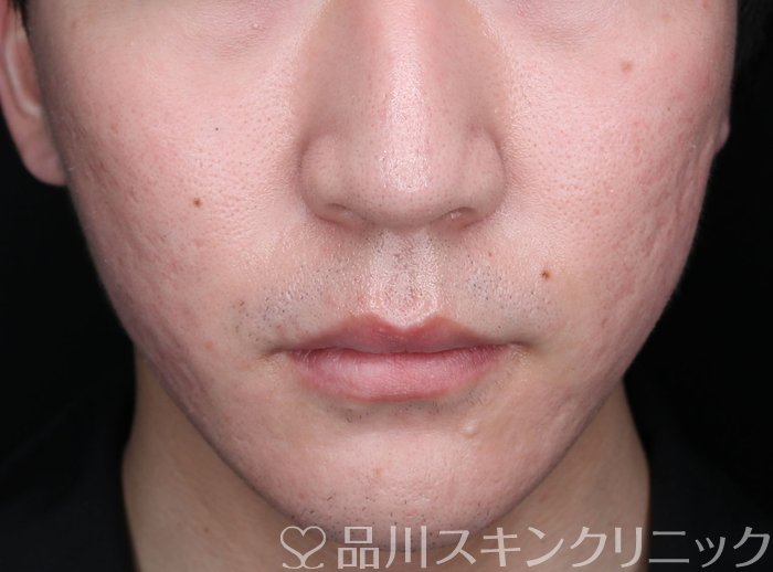 症例NO.74741のAFTER写真