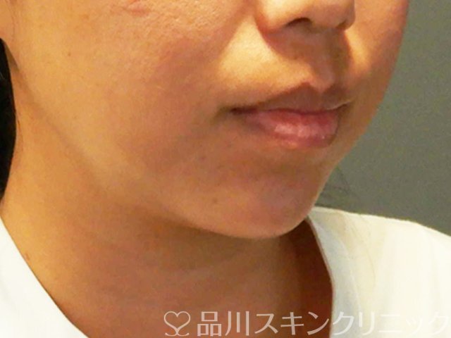 症例NO.66918のAFTER写真