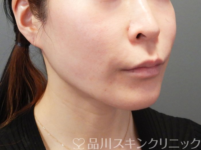 症例NO.68708のAFTER写真