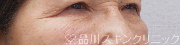 症例NO.70023のBEFORE写真