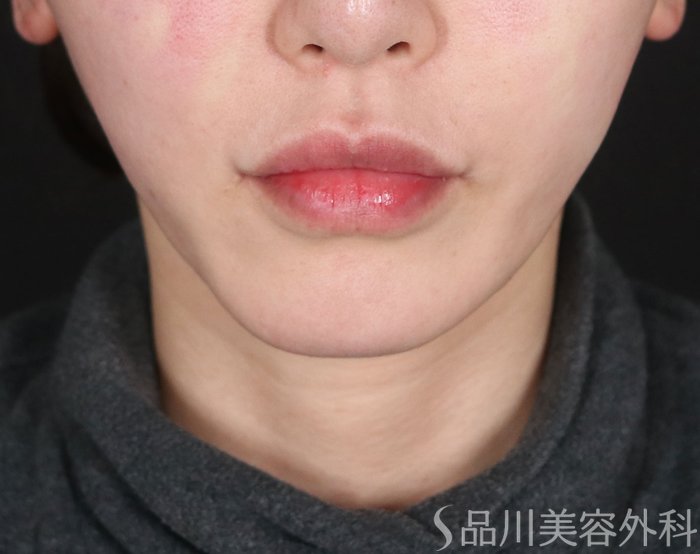 症例NO.73420のAFTER写真