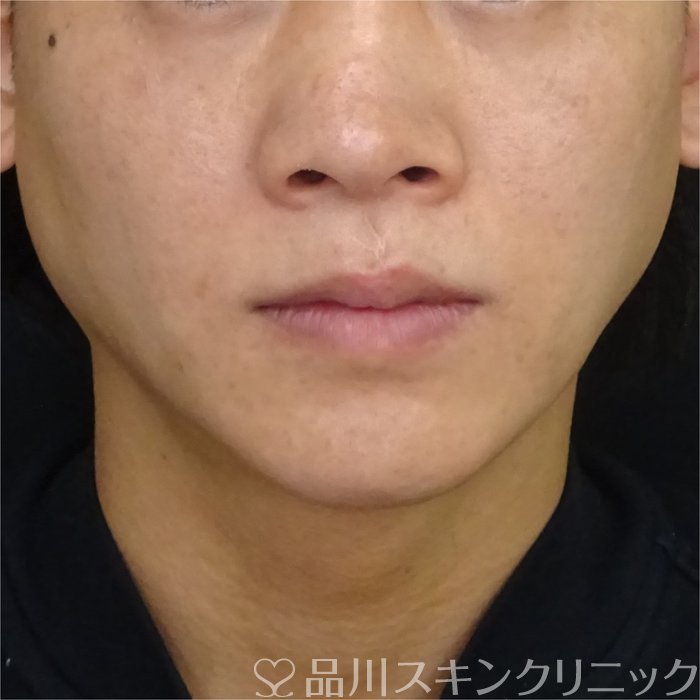 症例NO.69605のAFTER写真