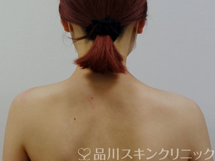 症例NO.73394のAFTER写真