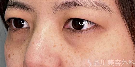 症例NO.54789のBEFORE写真