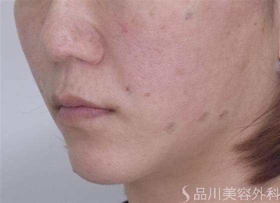 症例NO.50469のAFTER写真