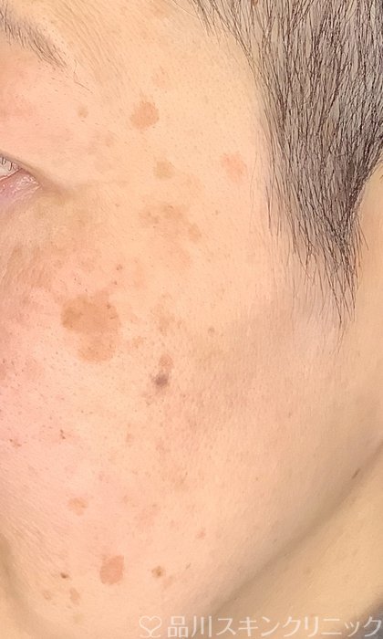 症例NO.71330のBEFORE写真