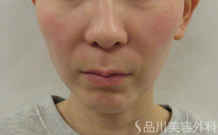 症例NO.72956のBEFORE写真