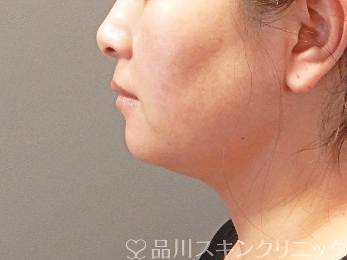 症例NO.63669のAFTER写真