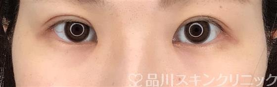 症例NO.52363のAFTER写真