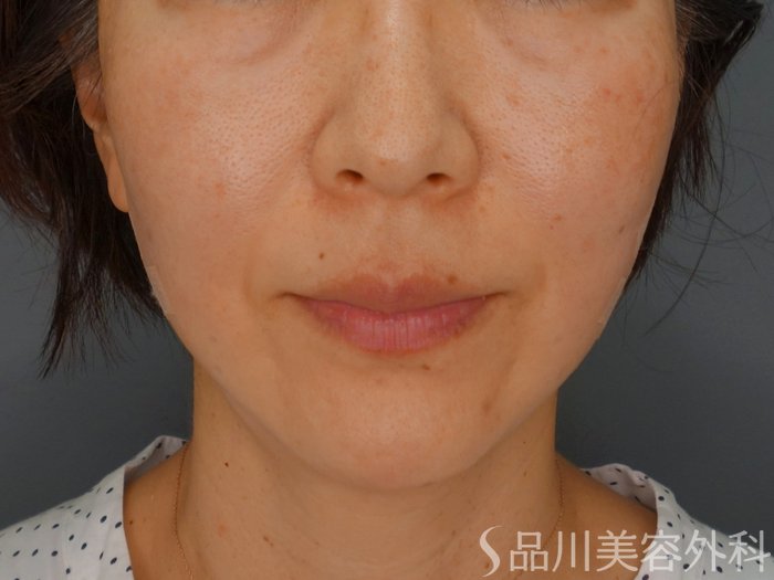 症例NO.74231のAFTER写真