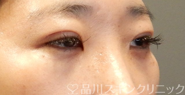 症例NO.64057のAFTER写真