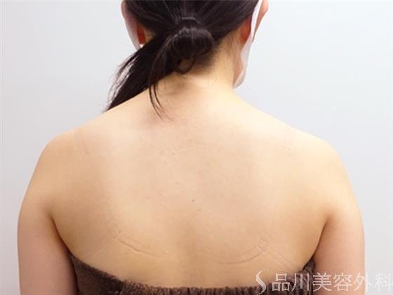 症例NO.52491のAFTER写真