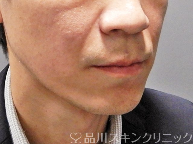 症例NO.68334のBEFORE写真