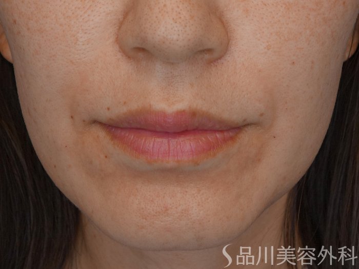 症例NO.74395のBEFORE写真