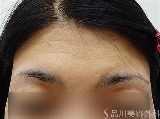 症例NO.36143のBEFORE写真
