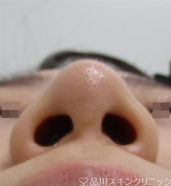 症例NO.43012のBEFORE写真