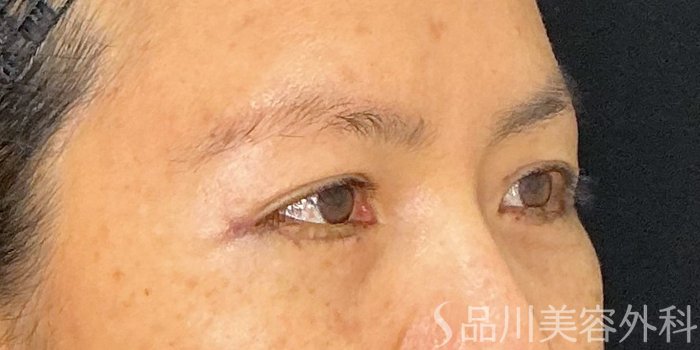 症例NO.73041のAFTER写真