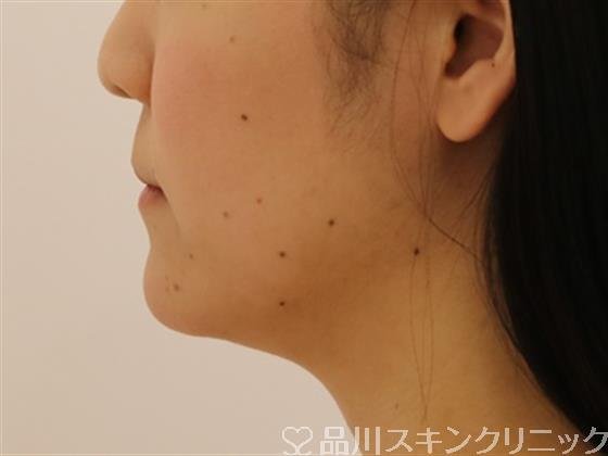 症例NO.45561のBEFORE写真