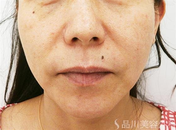 症例NO.24850のBEFORE写真