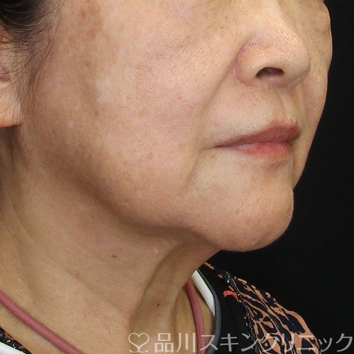 症例NO.74235のBEFORE写真