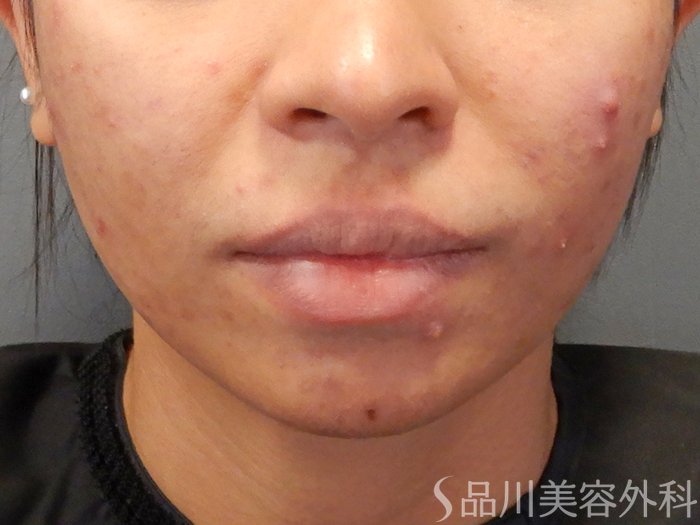 症例NO.70499のBEFORE写真