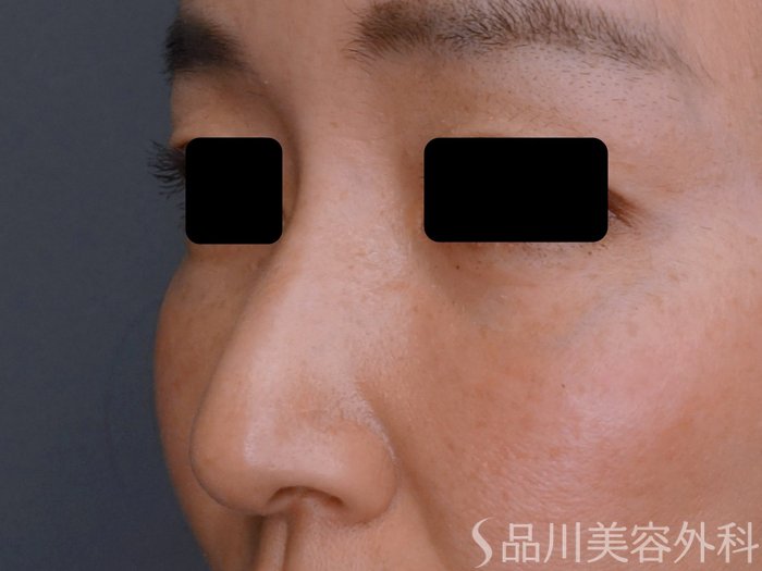 症例NO.75288のBEFORE写真