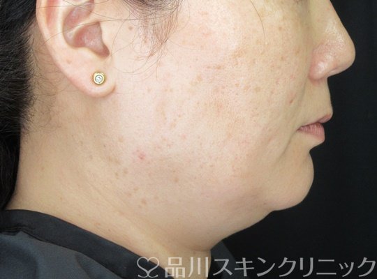 症例NO.70217のBEFORE写真