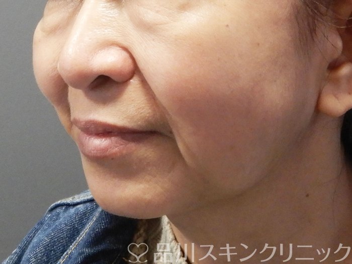 症例NO.73522のBEFORE写真