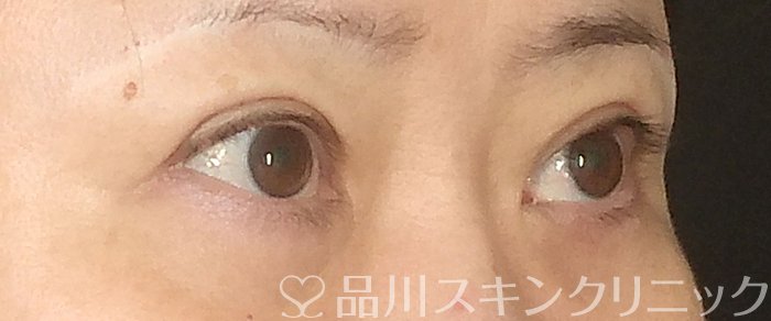 症例NO.68400のAFTER写真