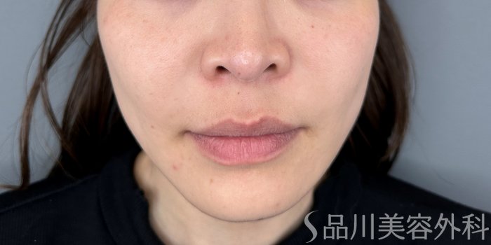 症例NO.70705のBEFORE写真