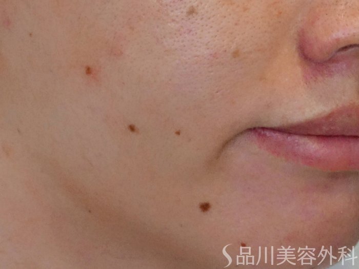 症例NO.72449のBEFORE写真