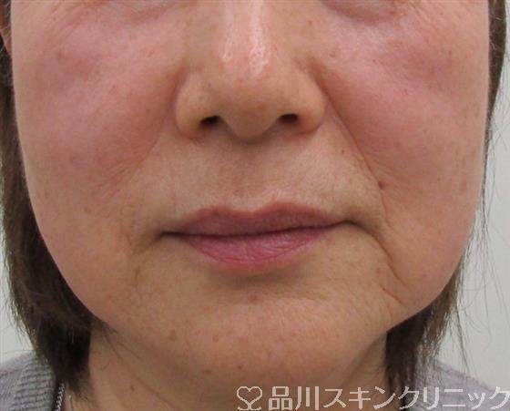症例NO.41092のBEFORE写真