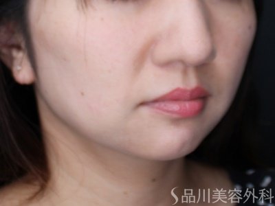 症例NO.64970のAFTER写真