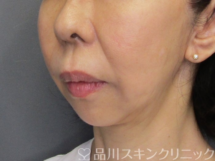 症例NO.75144のAFTER写真
