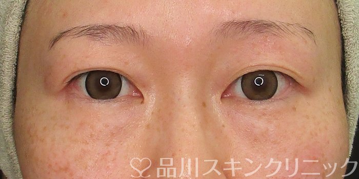 症例NO.70253のBEFORE写真