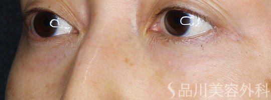 症例NO.72730のBEFORE写真