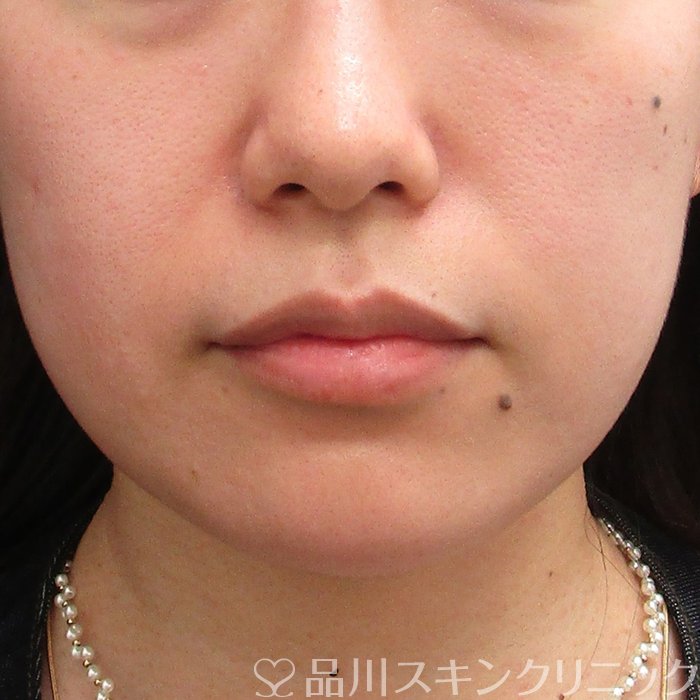 症例NO.74056のBEFORE写真
