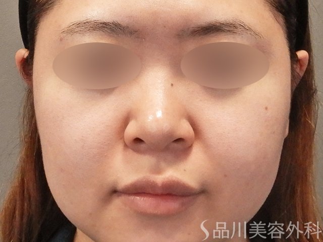 症例NO.75316のBEFORE写真