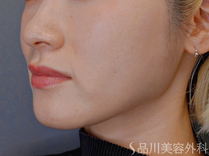 症例NO.74113のBEFORE写真