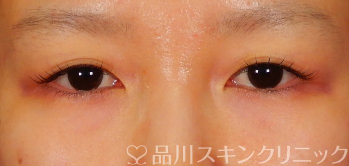症例NO.65787のBEFORE写真