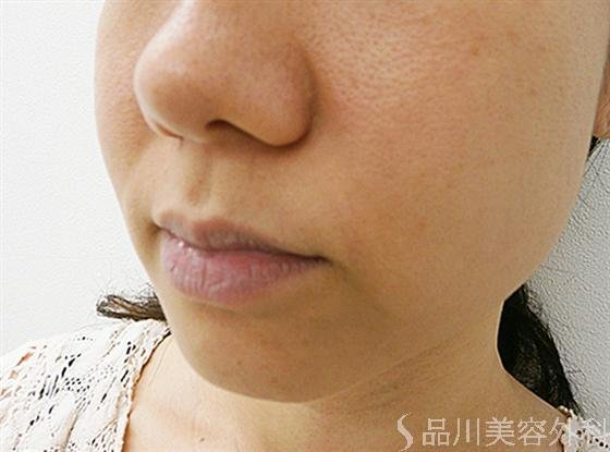 症例NO.14173のBEFORE写真