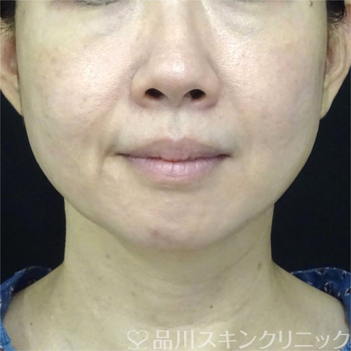 症例NO.72007のBEFORE写真