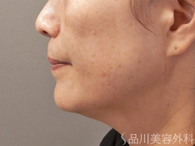症例NO.71831のAFTER写真