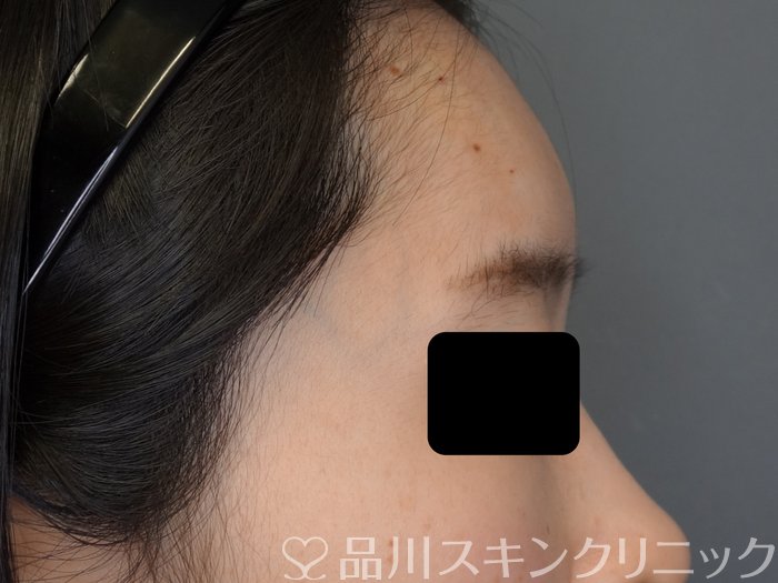 症例NO.74090のAFTER写真