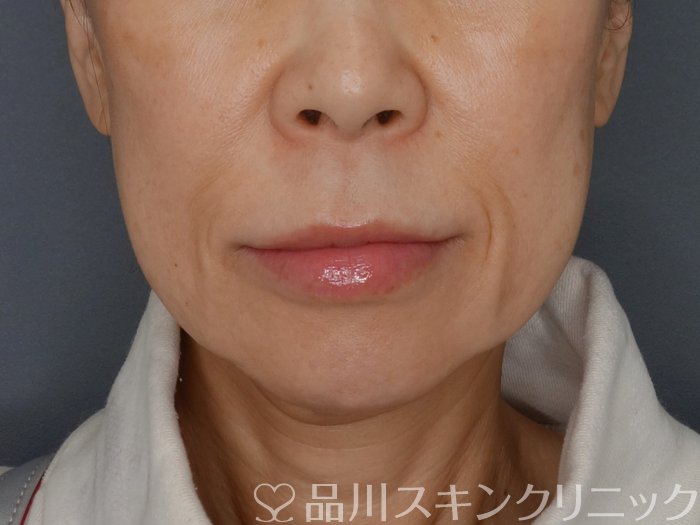 症例NO.72448のBEFORE写真