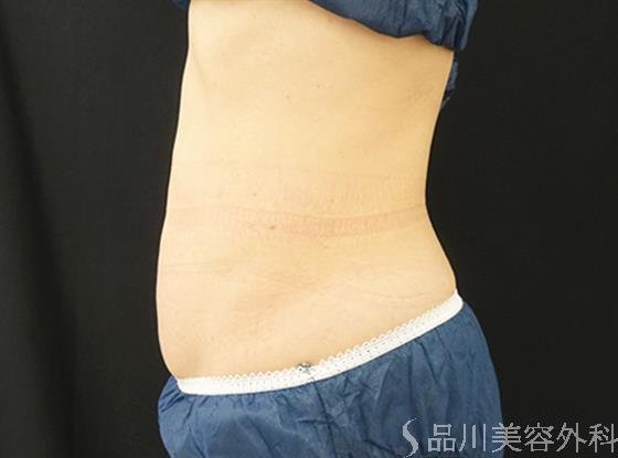 症例NO.44767のBEFORE写真