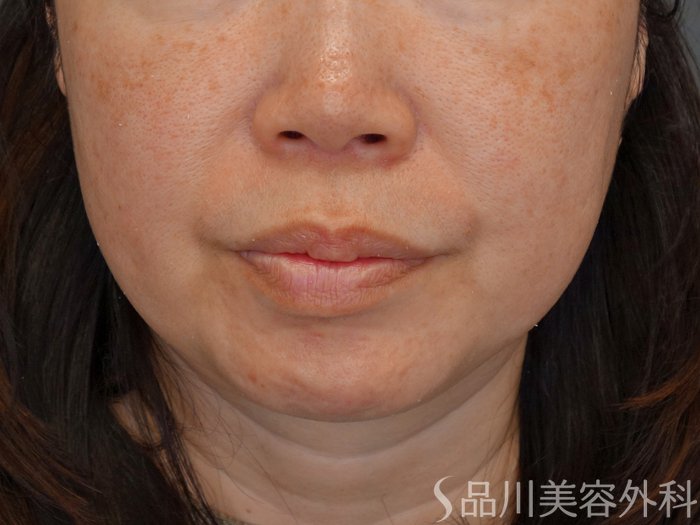 症例NO.73483のBEFORE写真